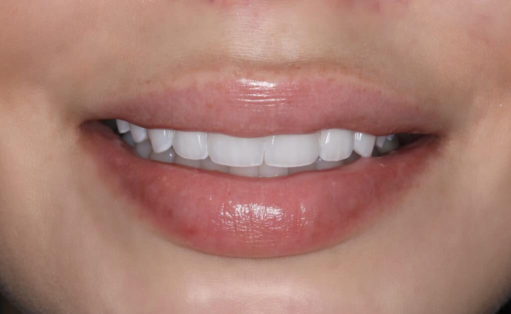 post top teeth