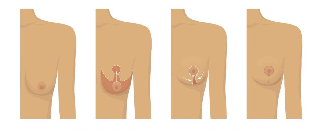 Perfecting Your Breast Lift Surgery 2 scars 2
